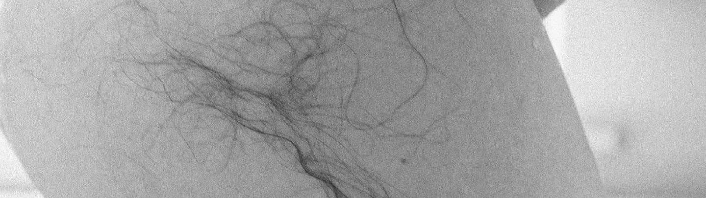 Chute de cheveux en post partum : comment faire ?