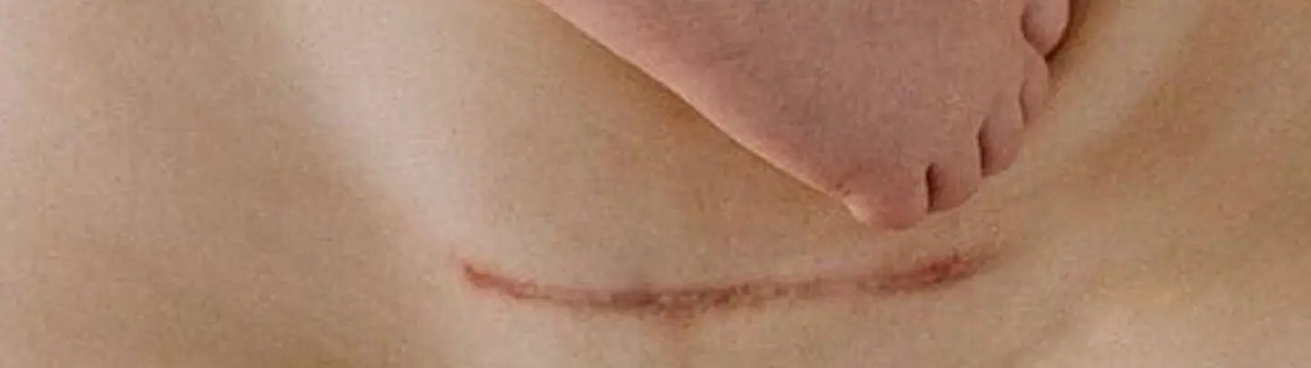 photo cicatrice césarienne et pieds bébé