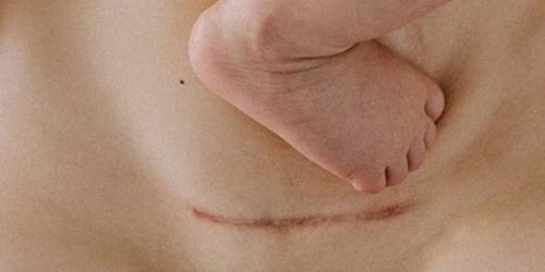 Accouchement Vaginal Après une Césarienne : Possible et Souhaitable