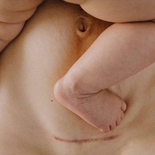 Femme tenant son bébé dans les bras et ayant une cicatrice suite à sa césarienne