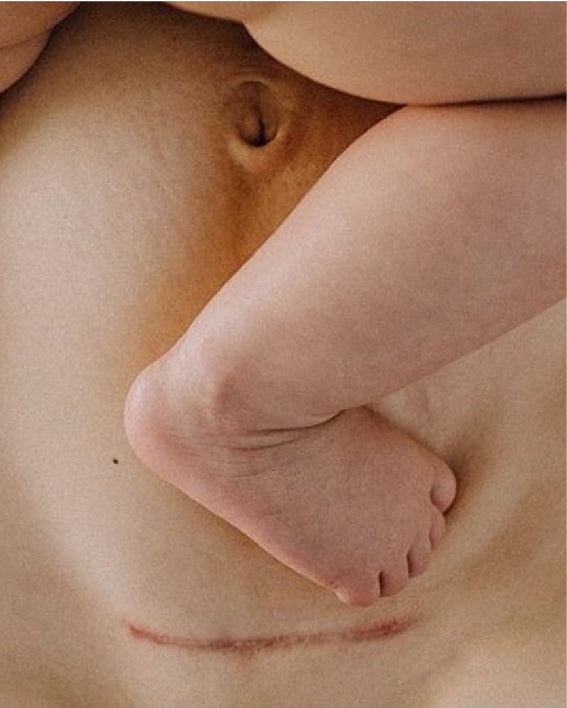 maman avec cesarienne et son bebe